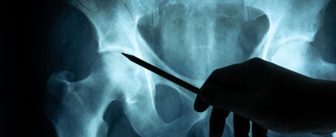 Come Curare le Calcificazioni con la Fisioterapia: Guida Completa