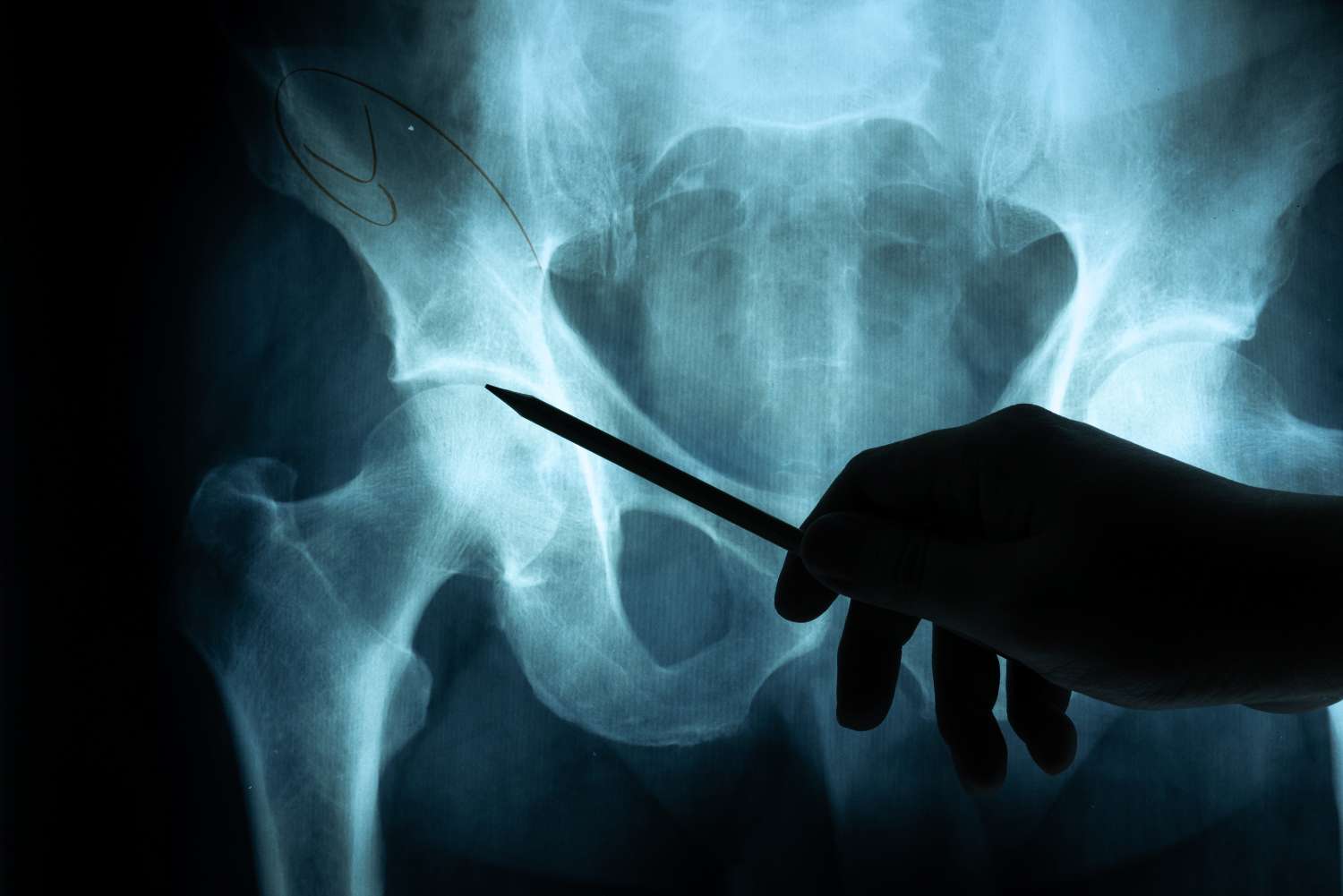 Come Curare le Calcificazioni con la Fisioterapia: Guida Completa
