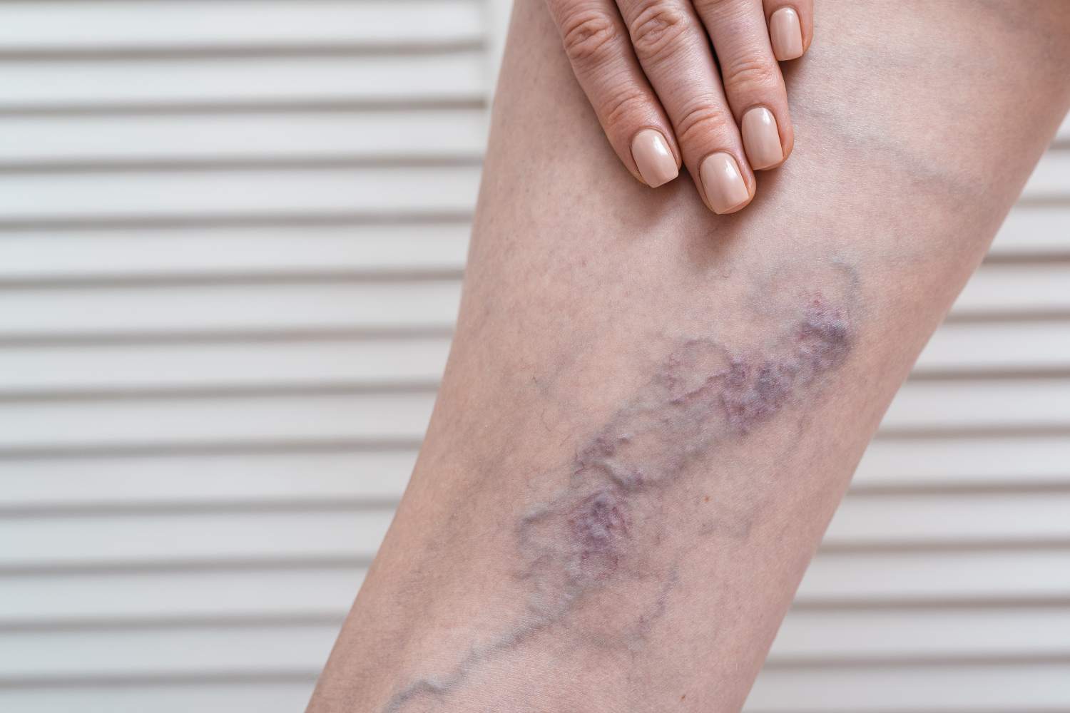 Arteriopatia periferica alle gambe: come riconoscerla e curarla